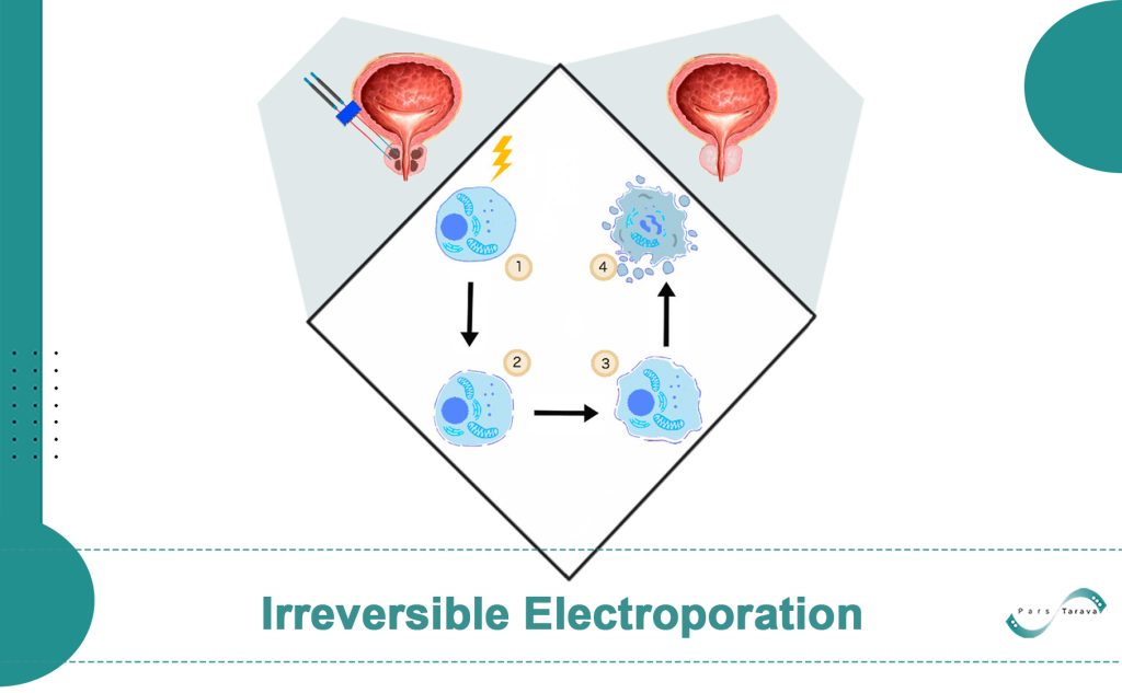 Irreversible Electroporation