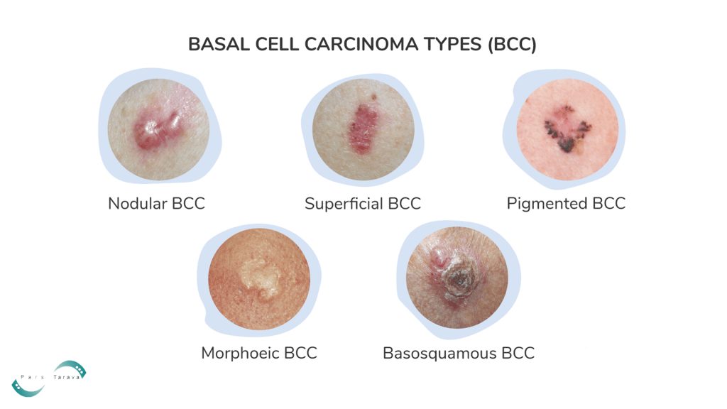 different types of Basal Cell Carcinoma