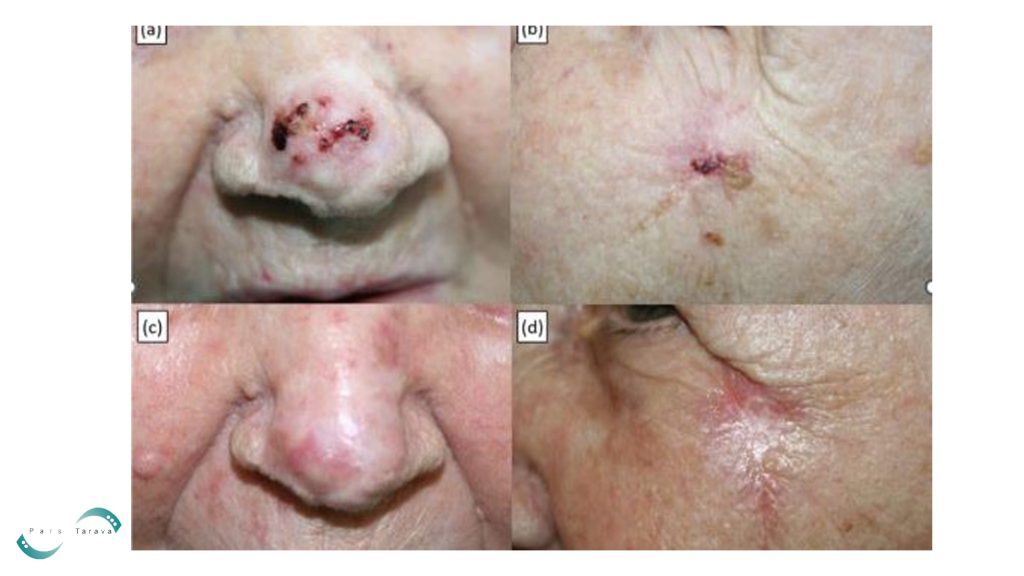 Basal Cell Carcinoma