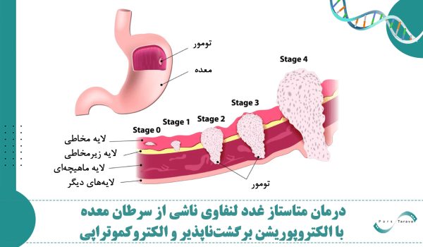 درمان متاستاز غدد لنفاوی ناشی از سرطان معده با ترکیبی از الکتروپوریشن برگشت ناپذیر و الکتروکموتراپی