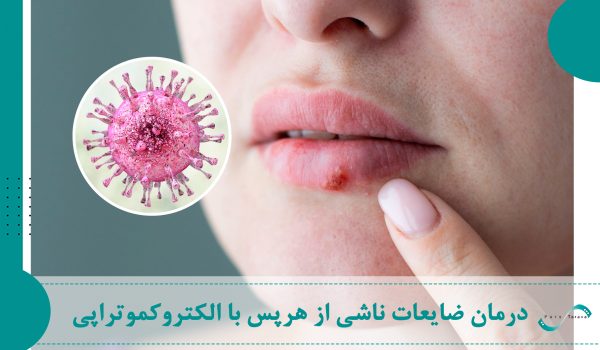 درمان ضایعات ناشی از هرپس با الکتروکموتراپی
