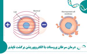 درمان سرطان پروستات با الکتروپوریشن برگشت ناپذیر