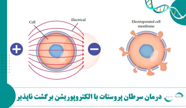 درمان سرطان پروستات با الکتروپوریشن برگشت ناپذیر