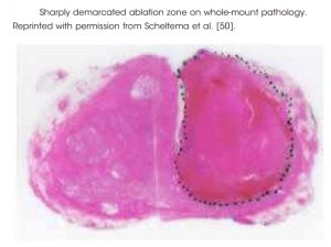 درمان سرطان پروستات با الکتروپوریشن برگشت ناپذیر