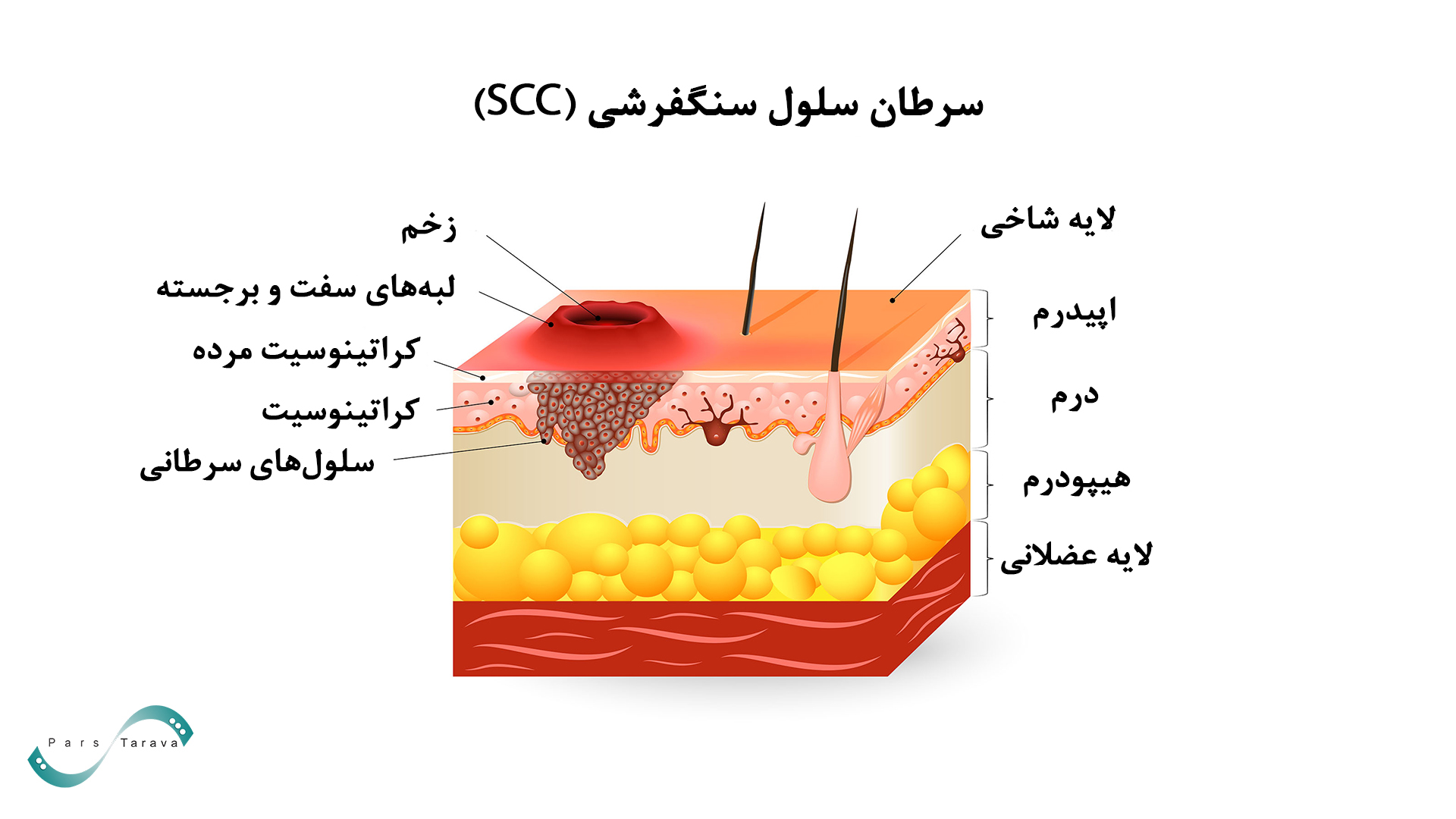 تومور در سرطان سلول سنگفرشی پوست SCC