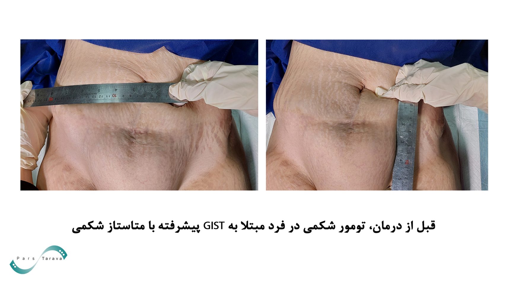 قبل از درمان تومور شکمی با الکتروکموتراپی