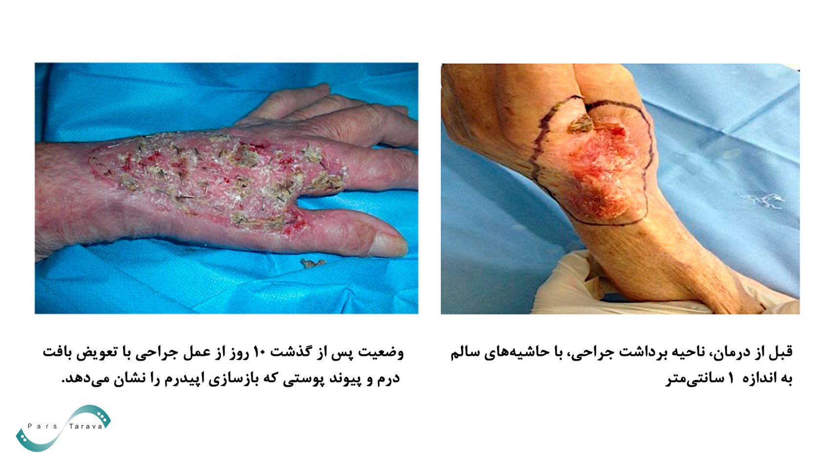 قبل و بعد از درمان سرطان پوست با الکتروکموتراپی