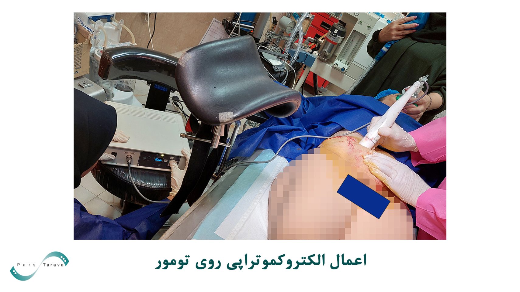 اعمال الکتروکموتراپی بر تومور استرومایی گوارشی