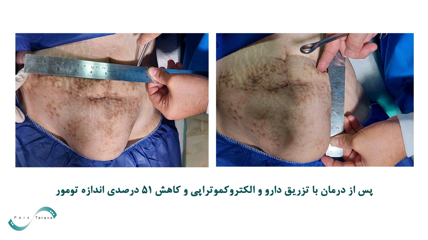 پس از درمان تومور شکمی با الکتروکموتراپی