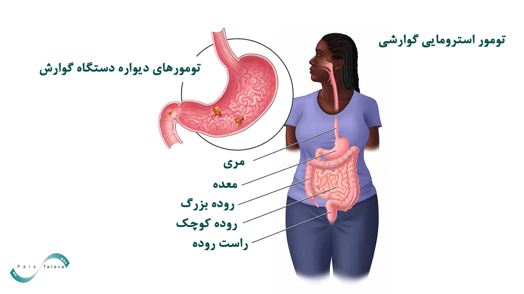 تومور استرومایی گوارشی