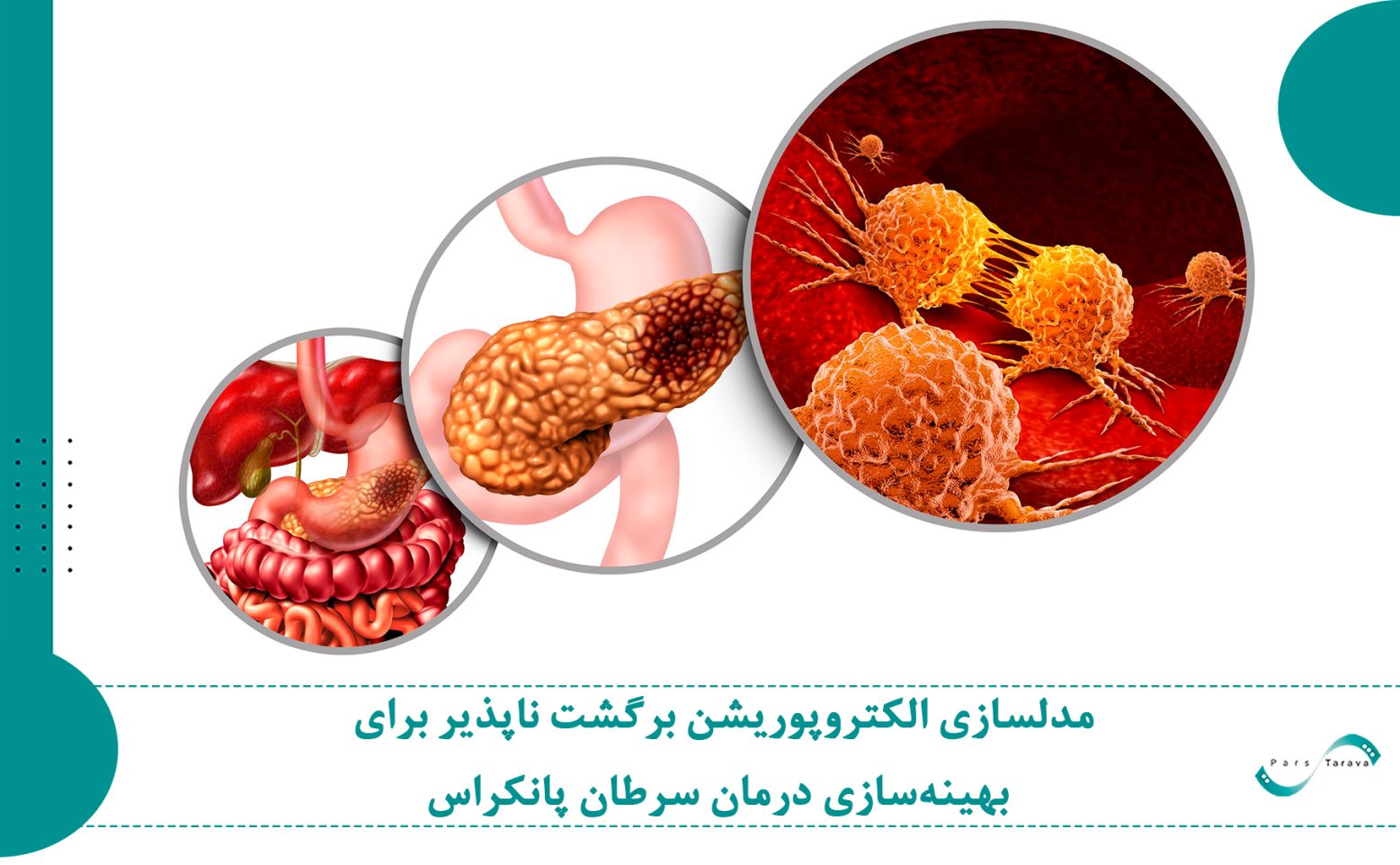 مدلسازی الکتروپوریشن برگشت ناپذیر برای بهینهسازی درمان سرطان پانکراس