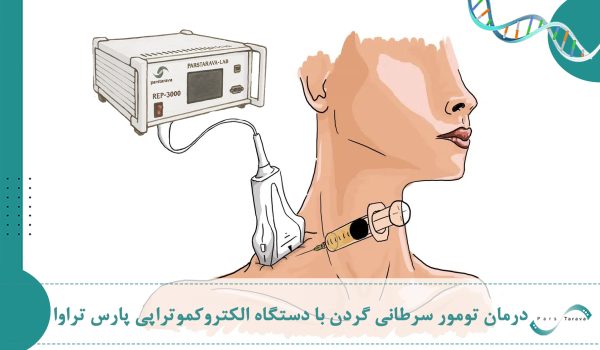 درمان تومور گردن ناشی از متاستاز سرطان سینه با دستگاه الکتروکموتراپی شرکت پارس تراوا