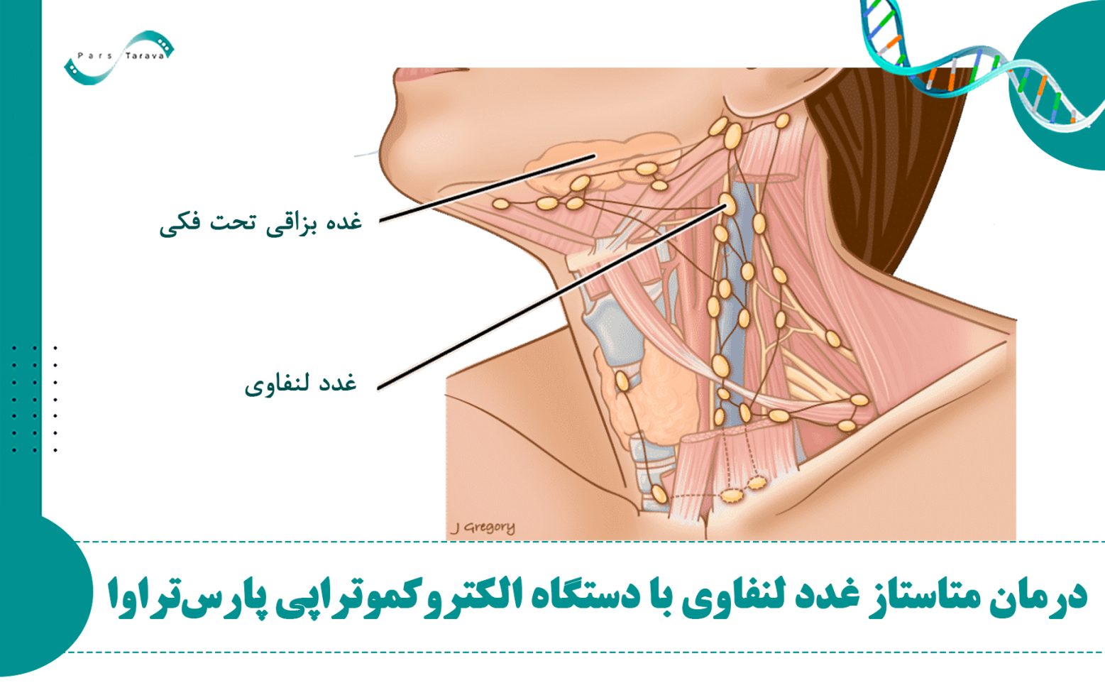 درمان موفق متاستاز غدد لنفاوی با دستگاه الکتروکموتراپی پارس تراوا: گزارش یک درمان موفق