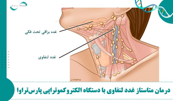 درمان موفق متاستاز غدد لنفاوی با دستگاه الکتروکموتراپی پارس تراوا: گزارش یک درمان موفق