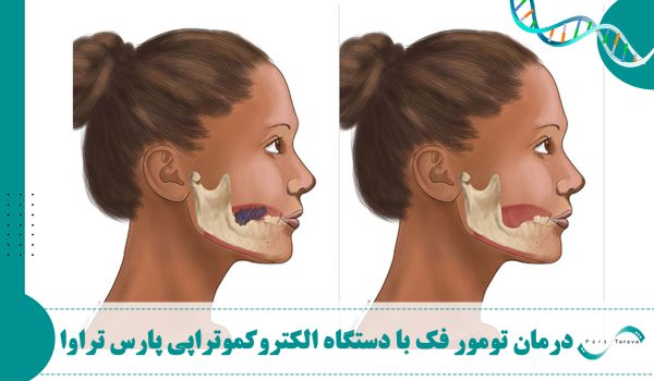 درمان تومور فک با الکتروکموتراپی شرکت پارس تراوا – گزارش یک مورد موفق و بررسی جامع