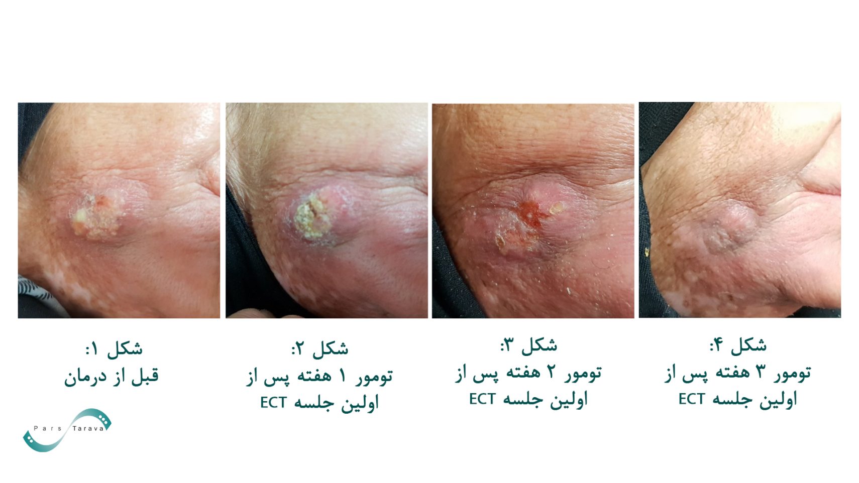 قبل و بعد درمان موفق تومور فک با الکتروکموتراپی شرکت پارس تراوا