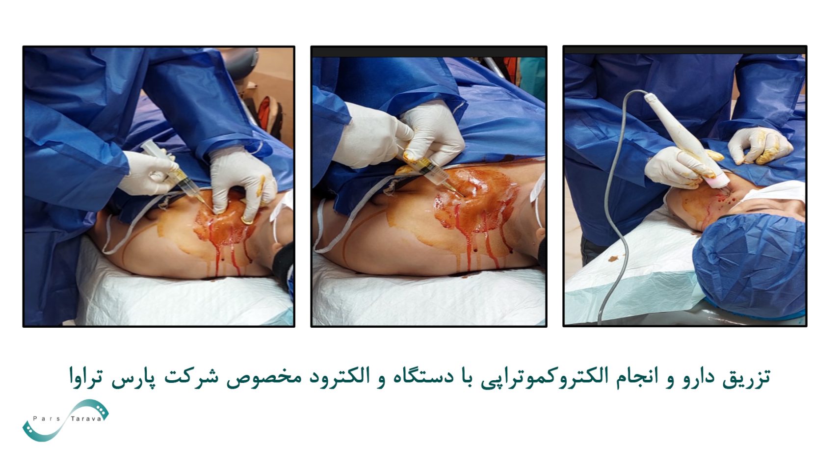درمان موفق متاستاز سرطان غدد لنفاوی ناشی از سرطان رحم با الکتروکموتراپی به کمک دستگاه پارس تراوا