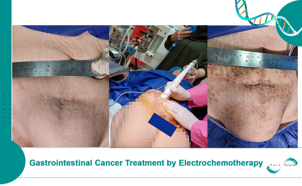 Gastrointestinal Cancer Treatment by Electrochemotherapy