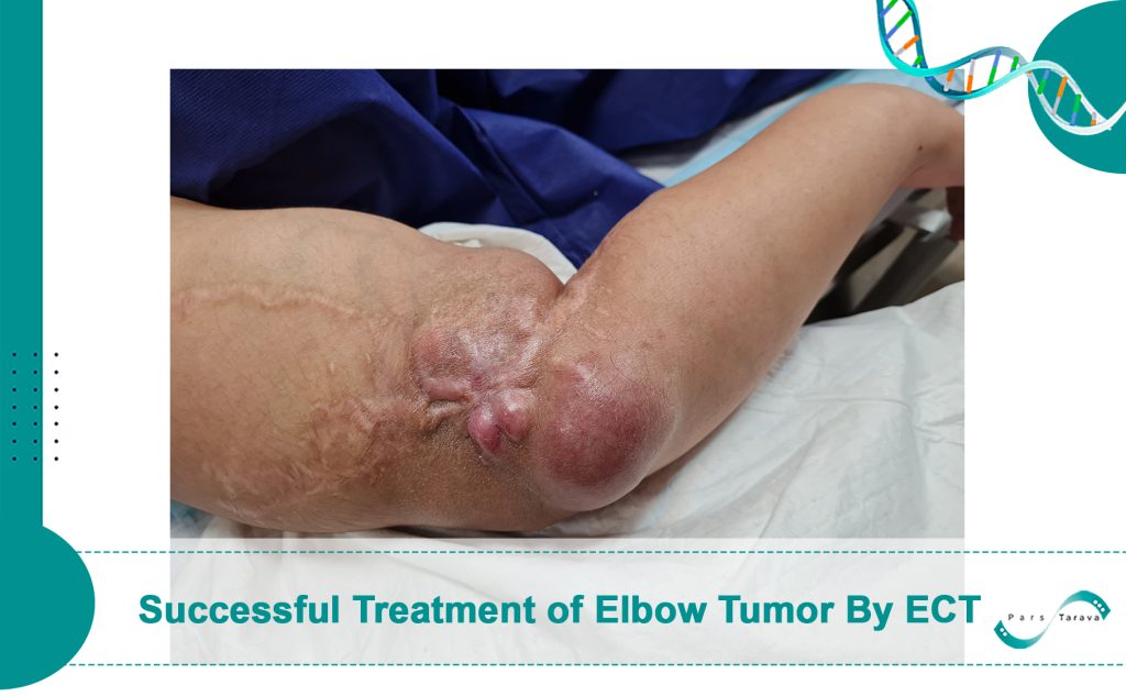 Successful Treatment of Elbow Tumor Using Electrochemotherapy