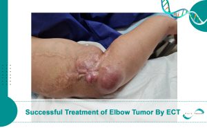 Successful Treatment of Elbow Tumor Using Electrochemotherapy