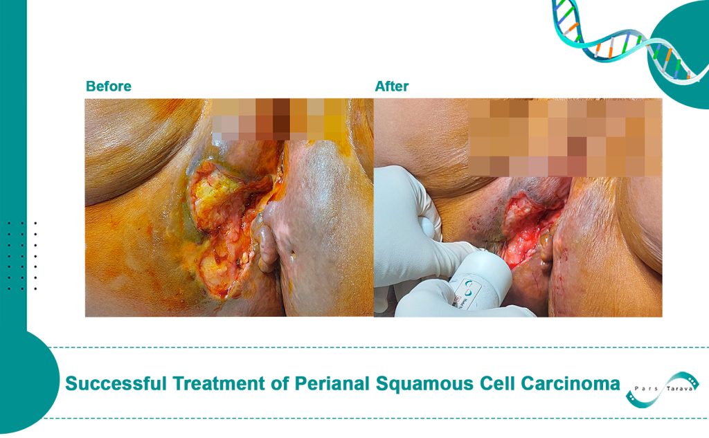 Successful Treatment of Perianal Squamous Cell Carcinoma Using Electrochemotherapy