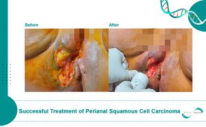 Successful Treatment of Perianal Squamous Cell Carcinoma Using Electrochemotherapy