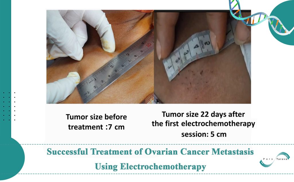 Successful Treatment of Ovarian Cancer Metastasis Using Electrochemotherapy with the Pars Tarava Device