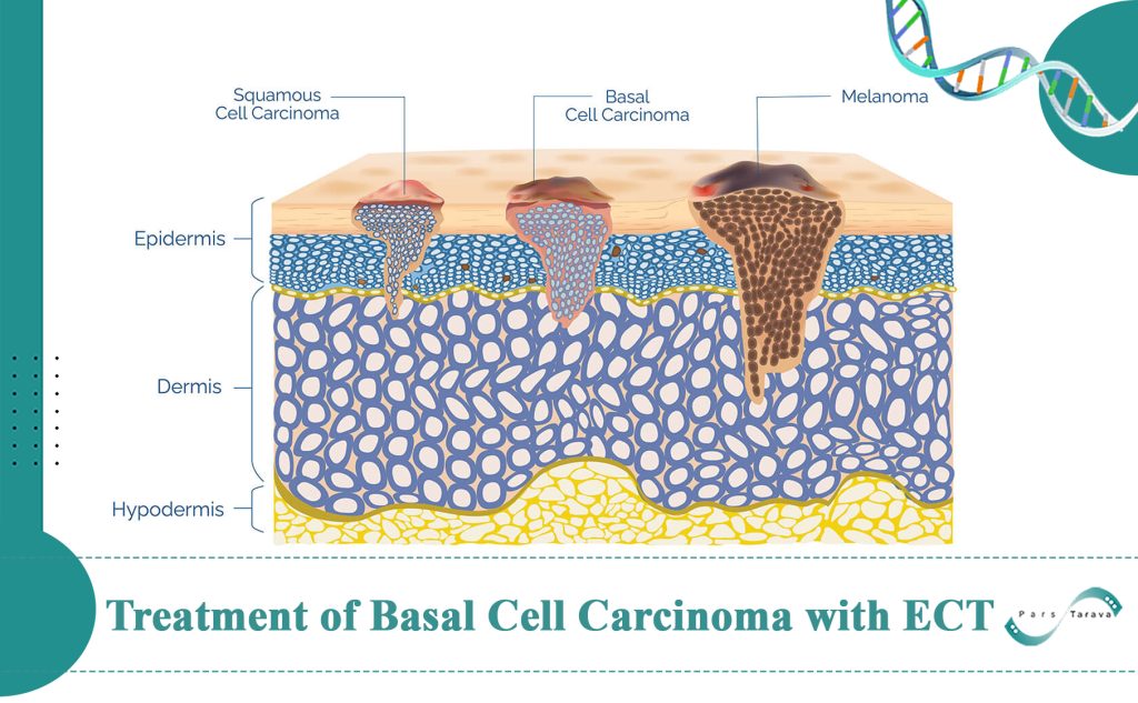 Treatment of Basal Cell Carcinoma with Electrochemotherapy