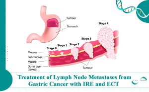 Treatment of Lymph Node Metastases from Gastric Cancer with a Combination of Irreversible Electroporation and Electrochemotherapy