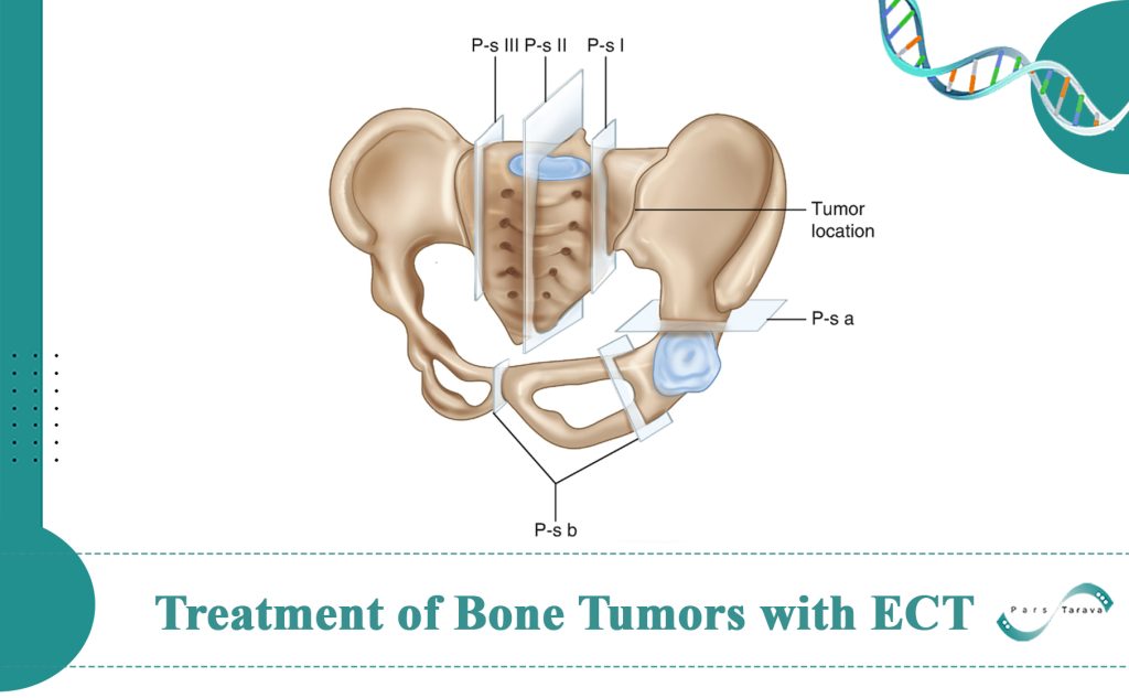 Treatment of Bone Tumors with Electrochemotherapy: Report of a Successful Treatment Case