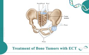 Treatment of Bone Tumors with Electrochemotherapy: Report of a Successful Treatment Case