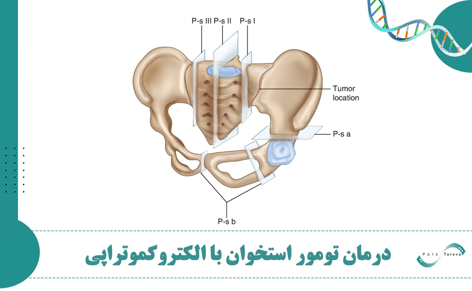 درمان تومور استخوان با دستگاه الکتروکموتراپی پارس تراوا