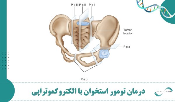درمان تومور استخوان با دستگاه الکتروکموتراپی پارس تراوا