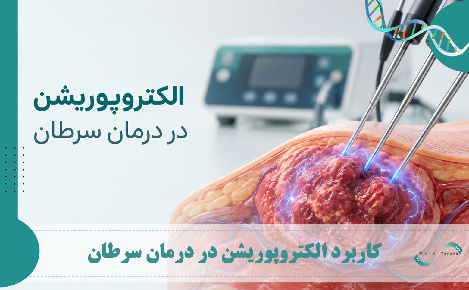 الکتروپوریشن در درمان سرطان و هدف قرار دادن تومور با پالس‌های الکتریکی