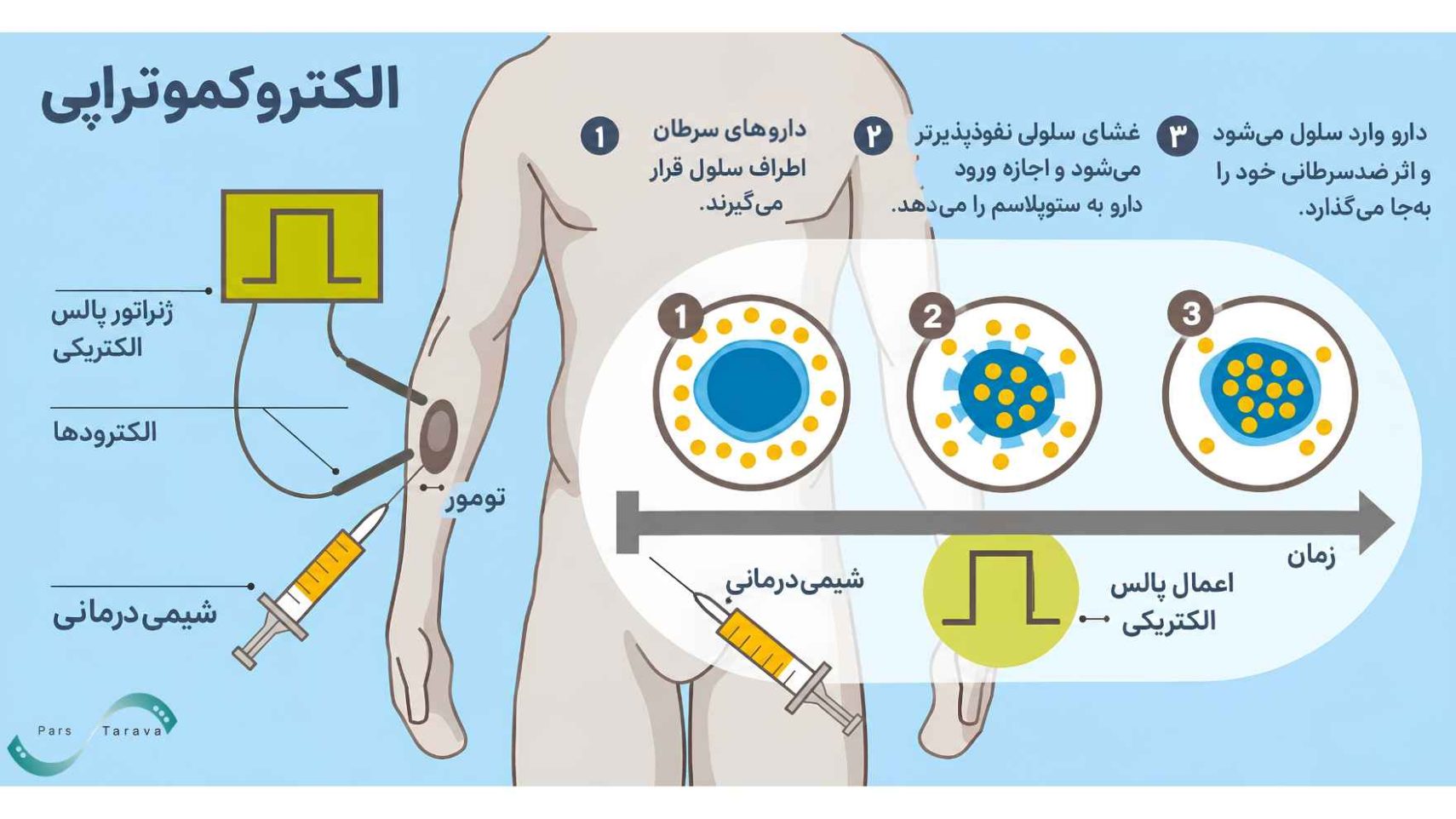 الکتروکموتراپی برای درمان سرطان